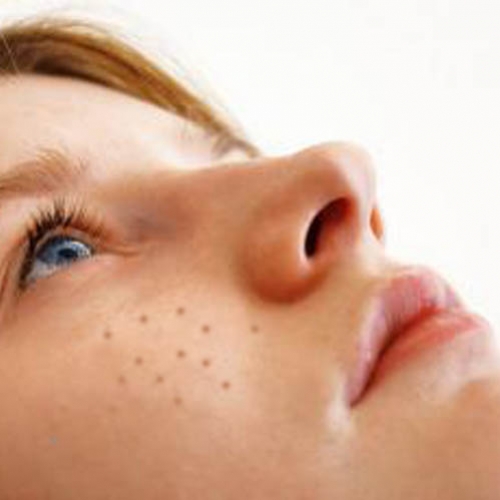 Acabe com a acne